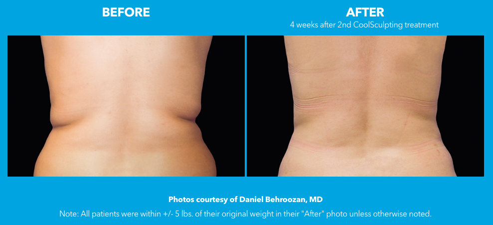 Cool Sculpting Treatment Before And And After