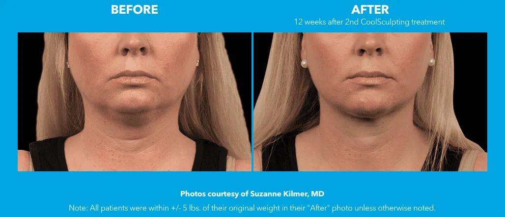 a comparison of a woman's face coolmini treatment