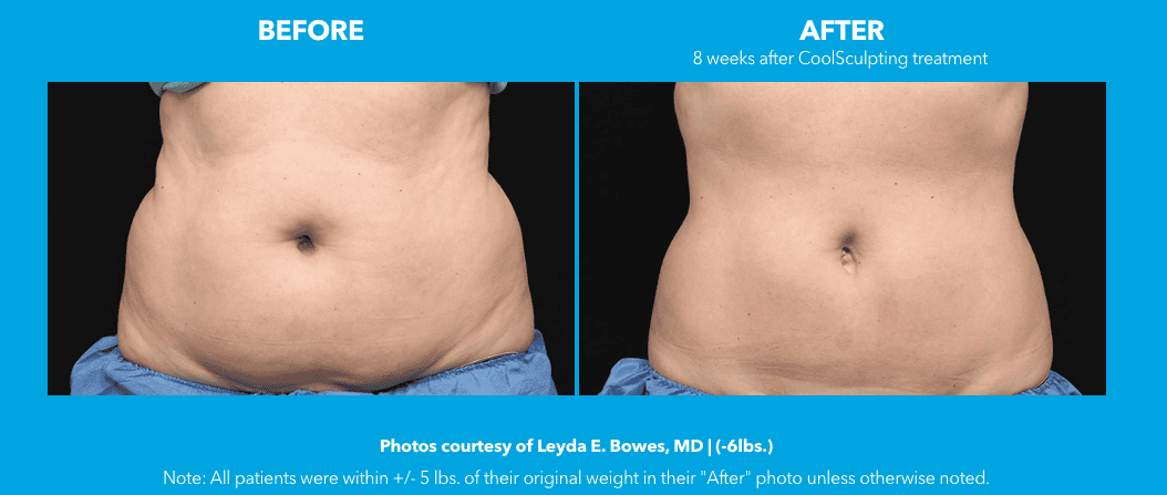 CoolSculpting Body Sculpting