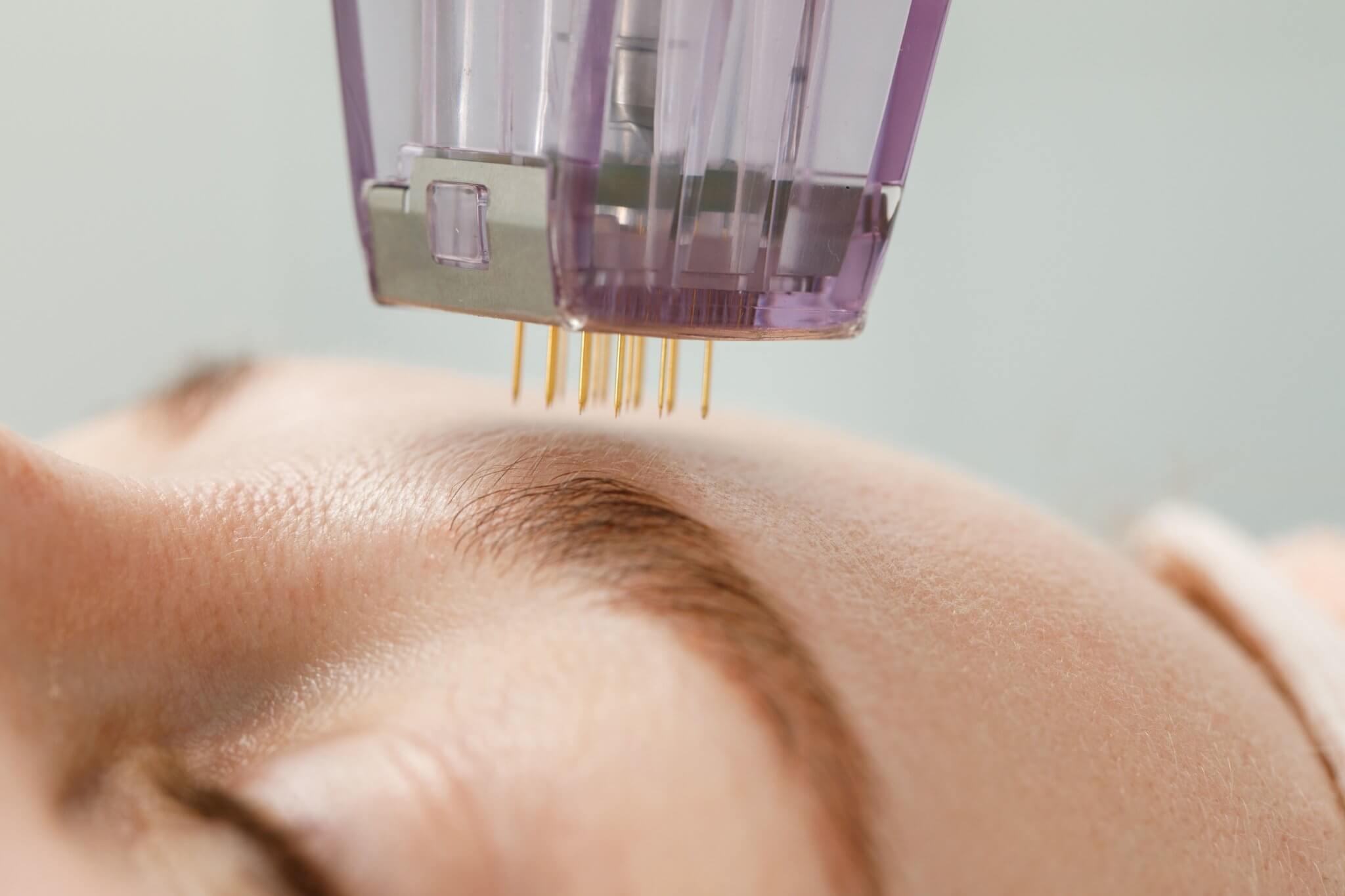 What Are The Benefits To Microneedling?