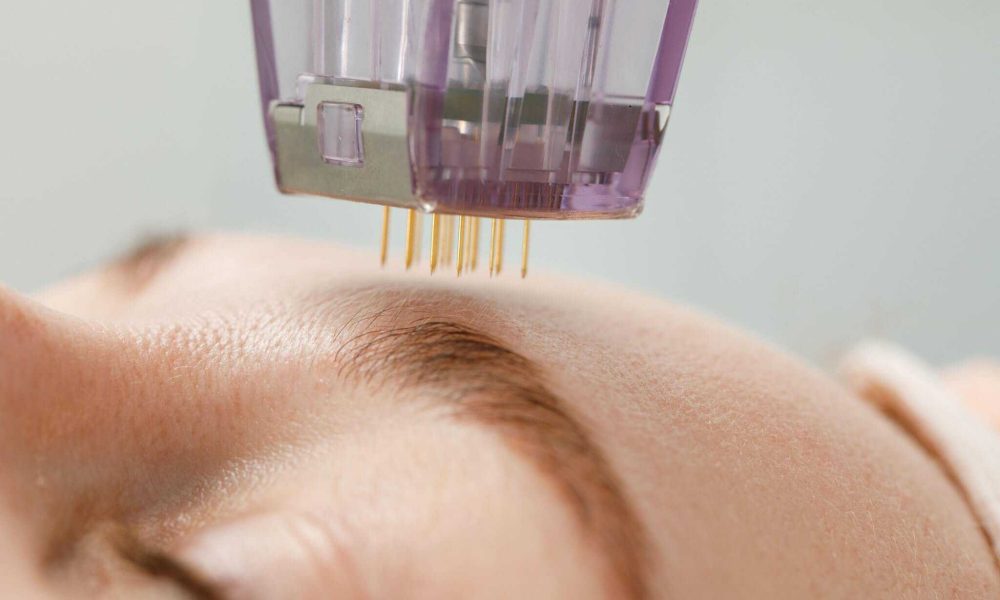 What Are The Benefits To Microneedling?