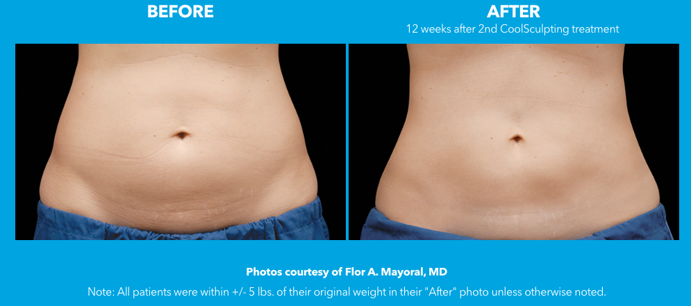 Coolsculpting Before And After Sculpting