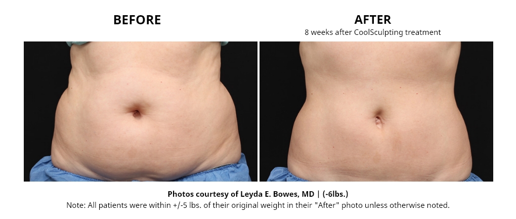 coolsculpting-befor after images-magnolia-medical-aesthetics
