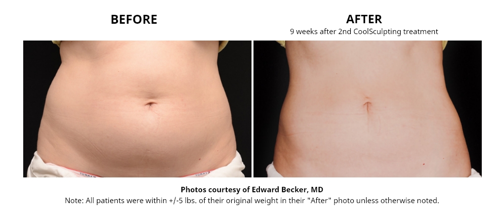 coolsculpting-befor after images-magnolia-medical-aesthetics