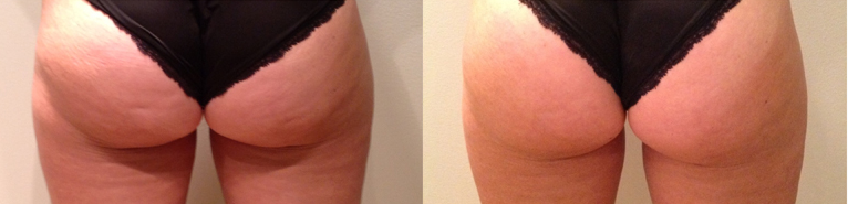 venuslegacy Before And After Magnolia BodySculpting