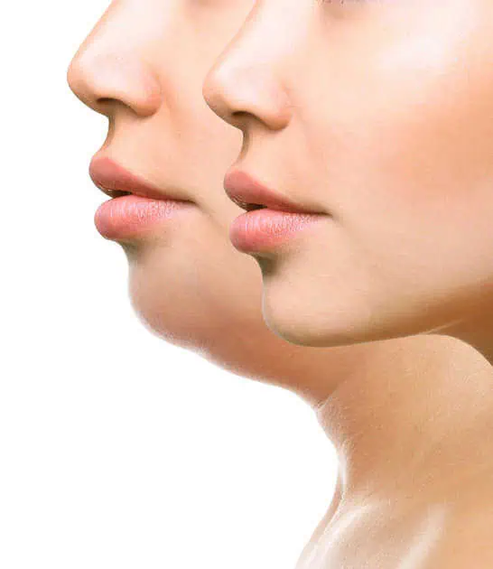 Kybella for double chin, Kybella, Kybella Treatment, Benefits of Kybella, Kybella Before and After, Kybella Results, Double chin Reduction, Double chin removal, Kybella Treatment