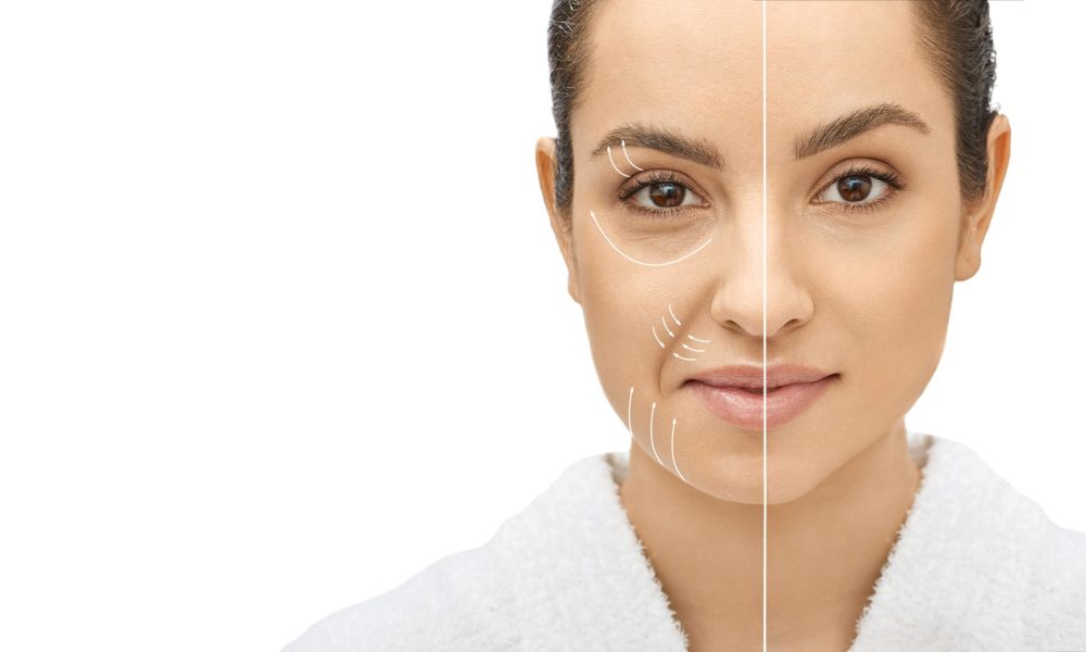 Venus Viva Skin Tightening & Skin Resurfacing Treatments